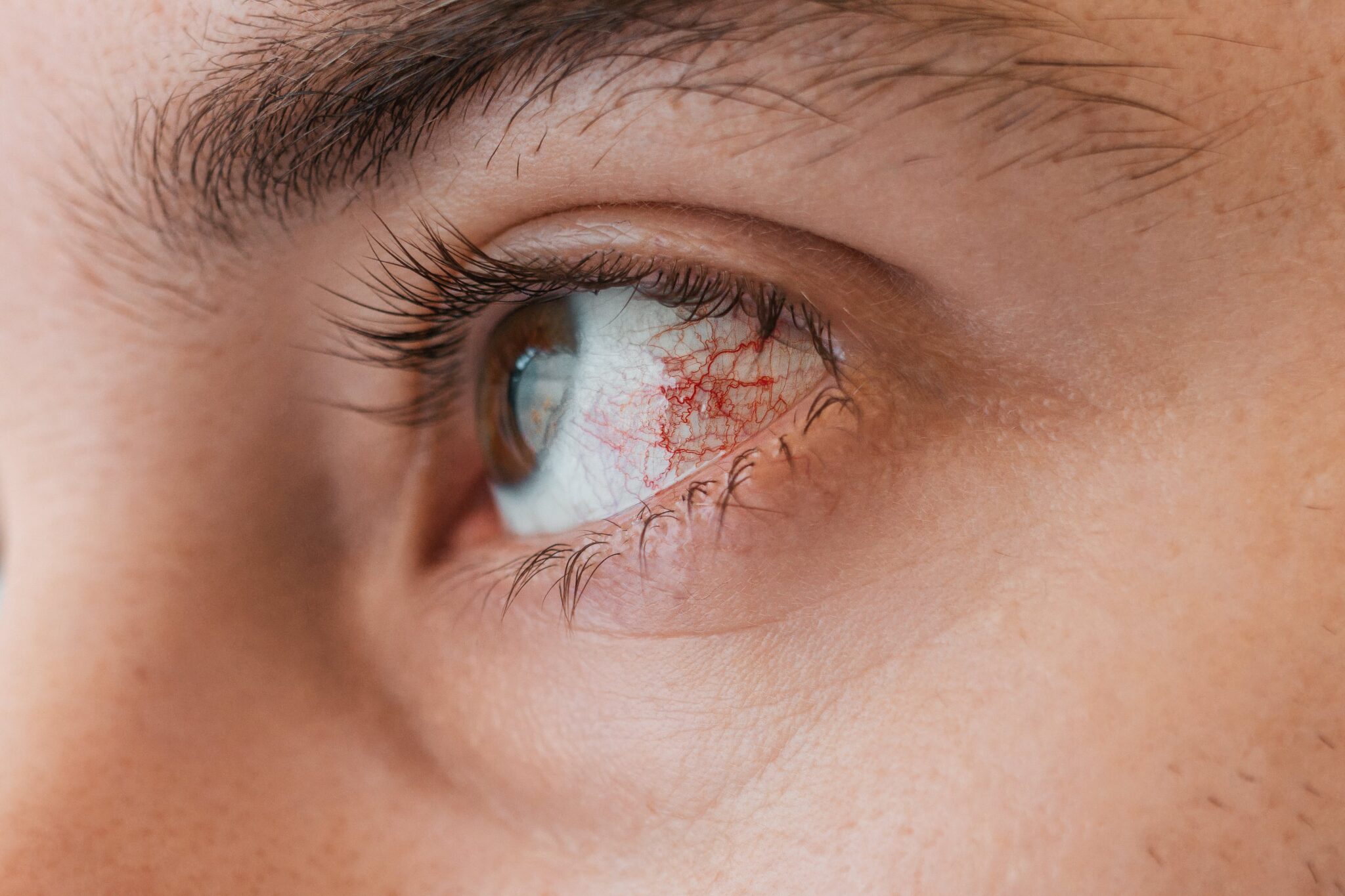 Dry Eye Treatment in Mandan, ND | Vision Source Mandan