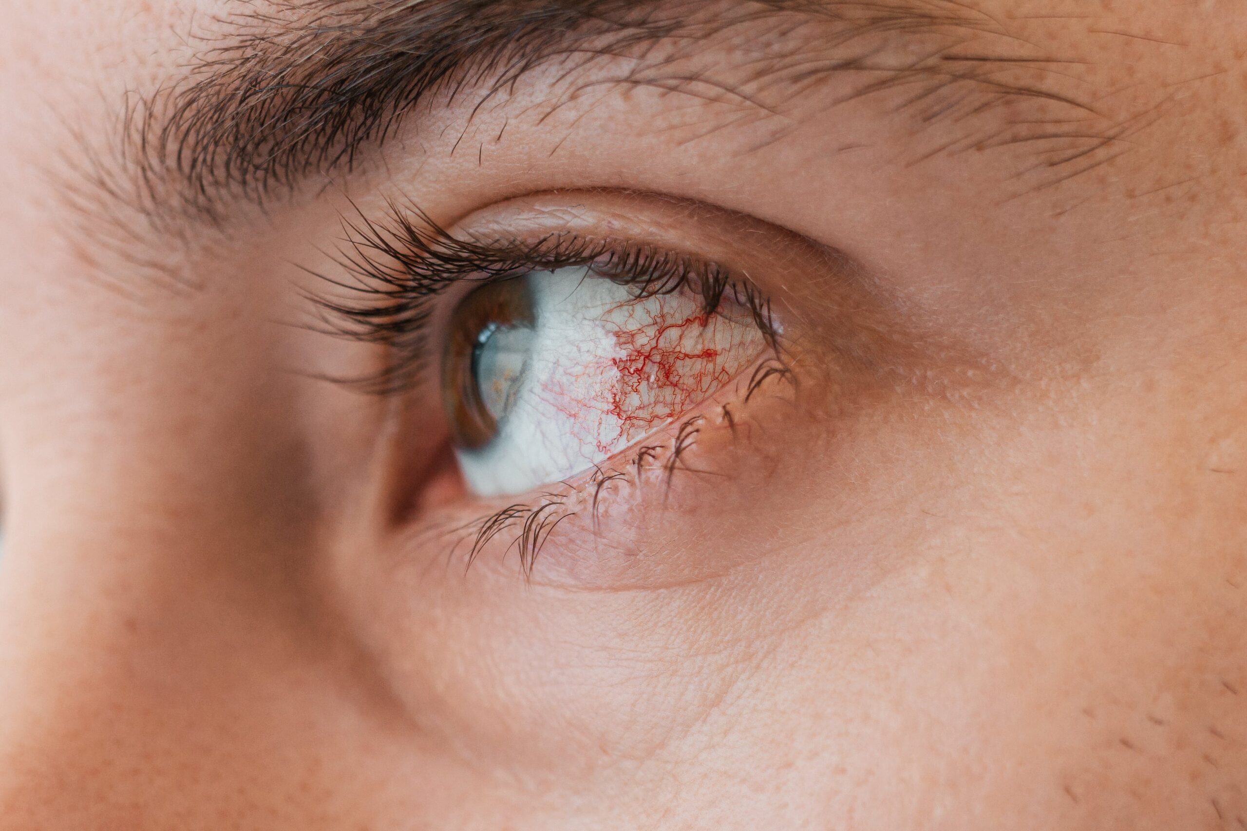 Dry Eye Disease