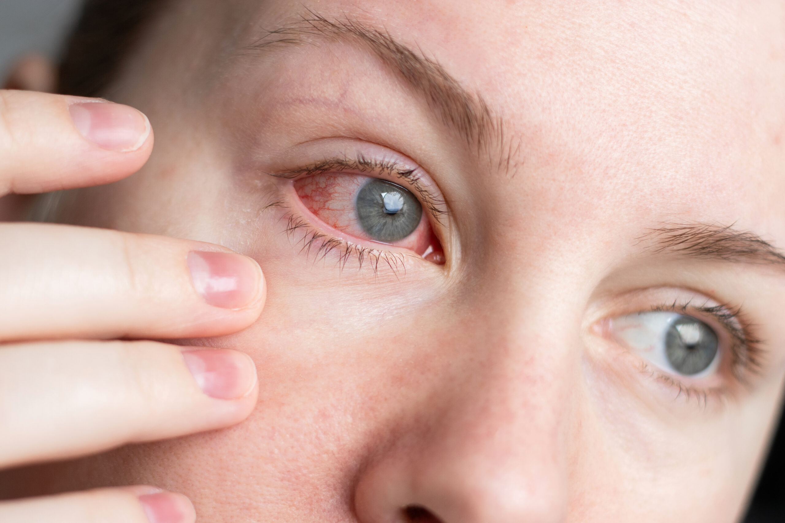 Dry Eye Disease scaled - Vision Source Mandan