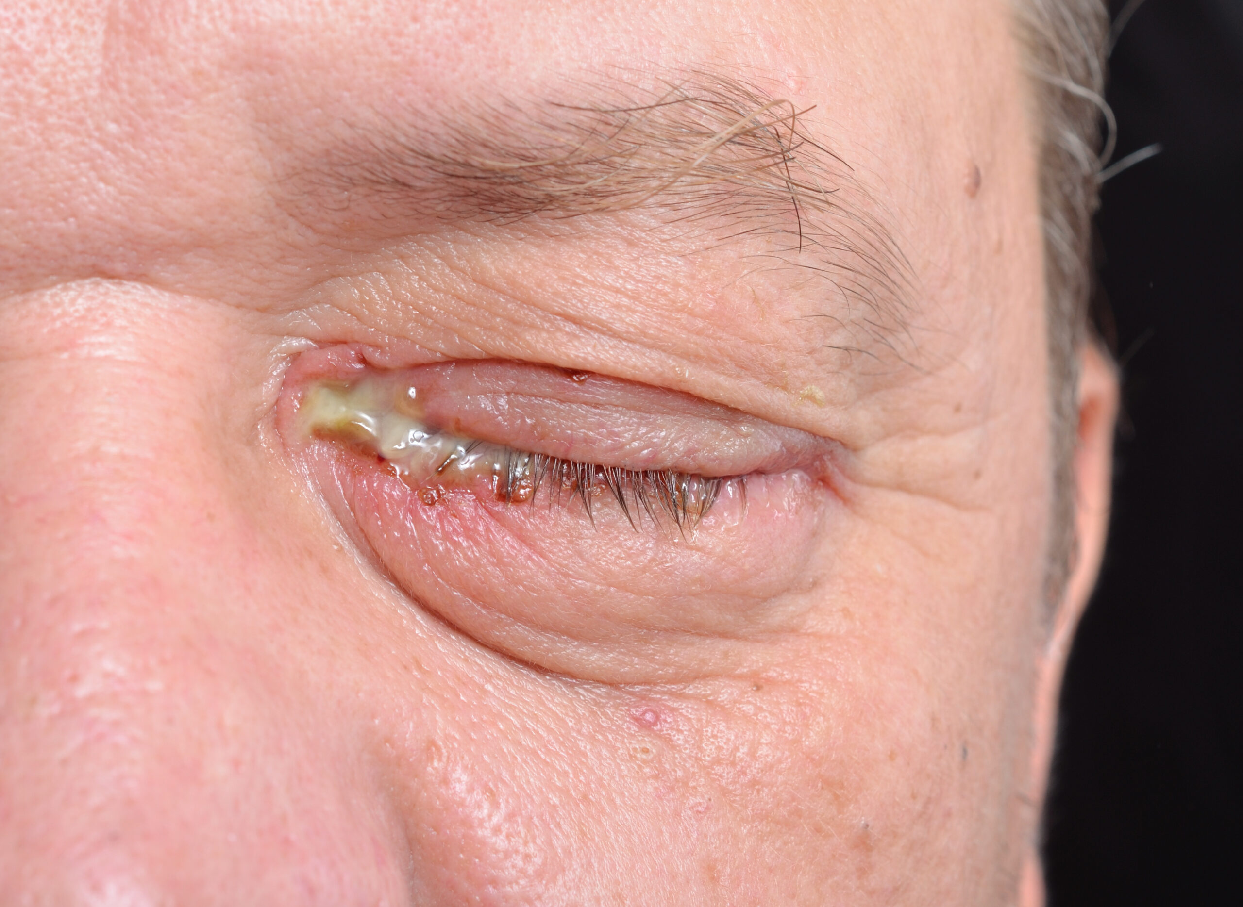 Pink Eye scaled - Vision Source Mandan