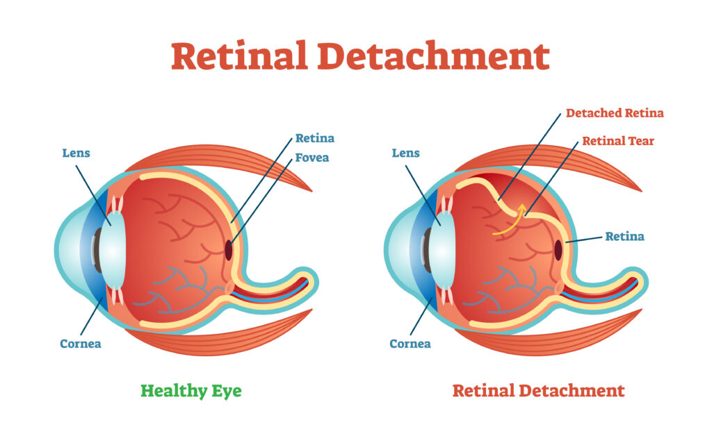 Retinal Detachment - Vision Source Mandan