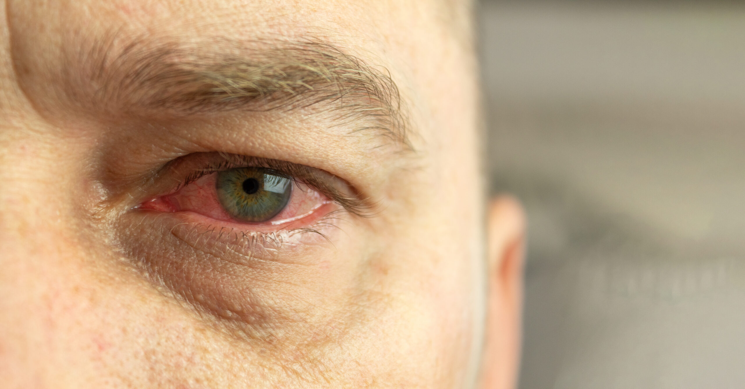 Retinal Trauma scaled - Vision Source Mandan