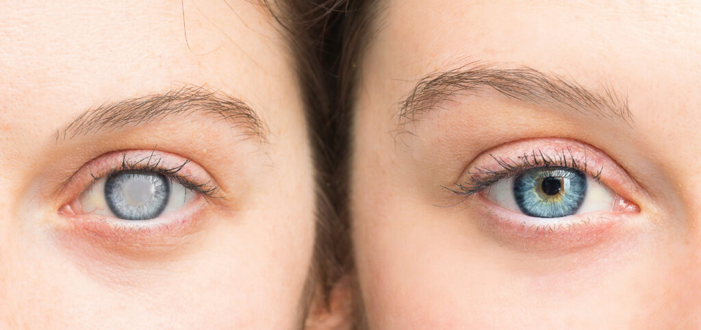 cataract - Vision Source Mandan