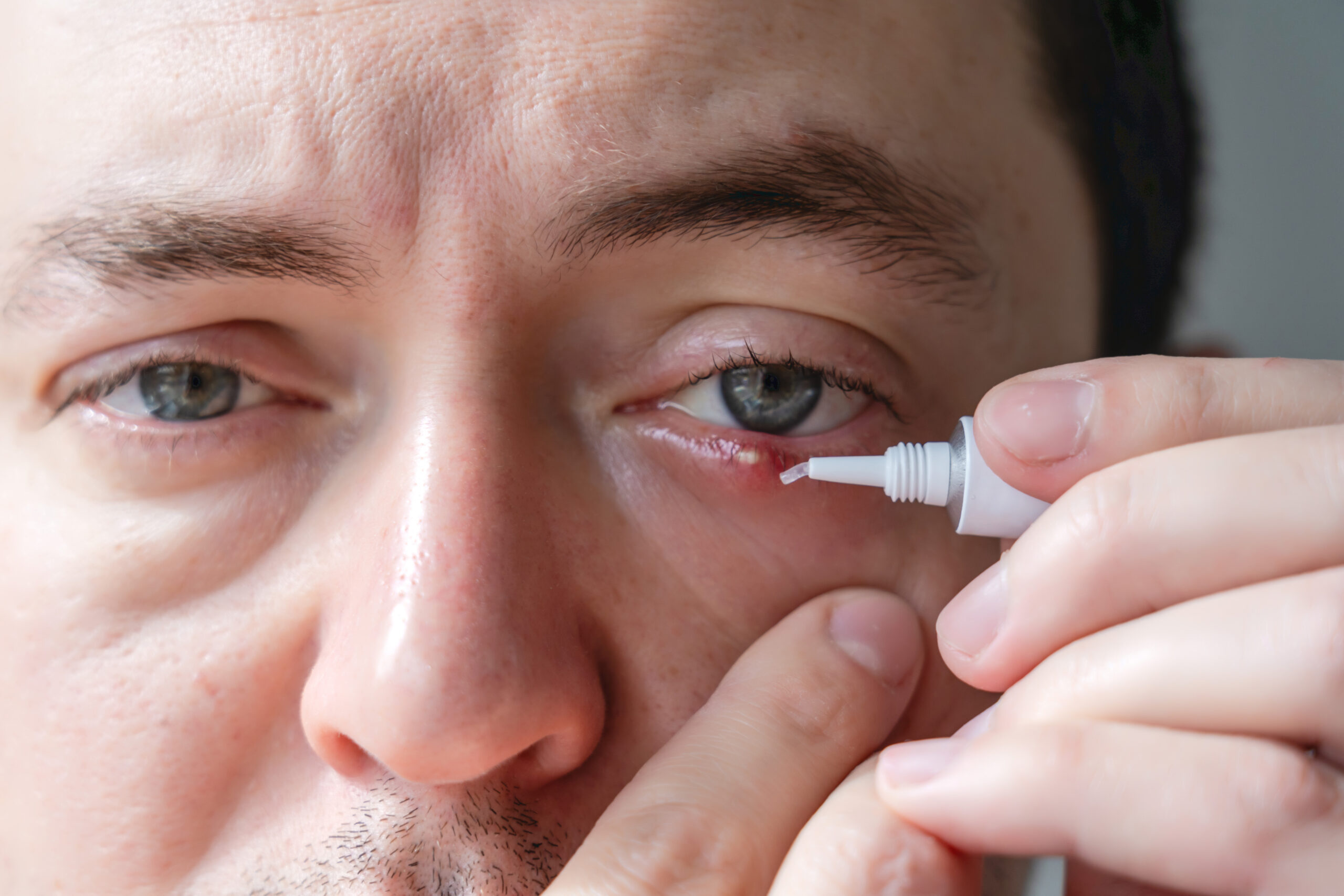Close up of a man's infected chalazion (stye, barley) or hordeolum eye with ointment. Viral Infection. Staphylococcus. Ophthalmology