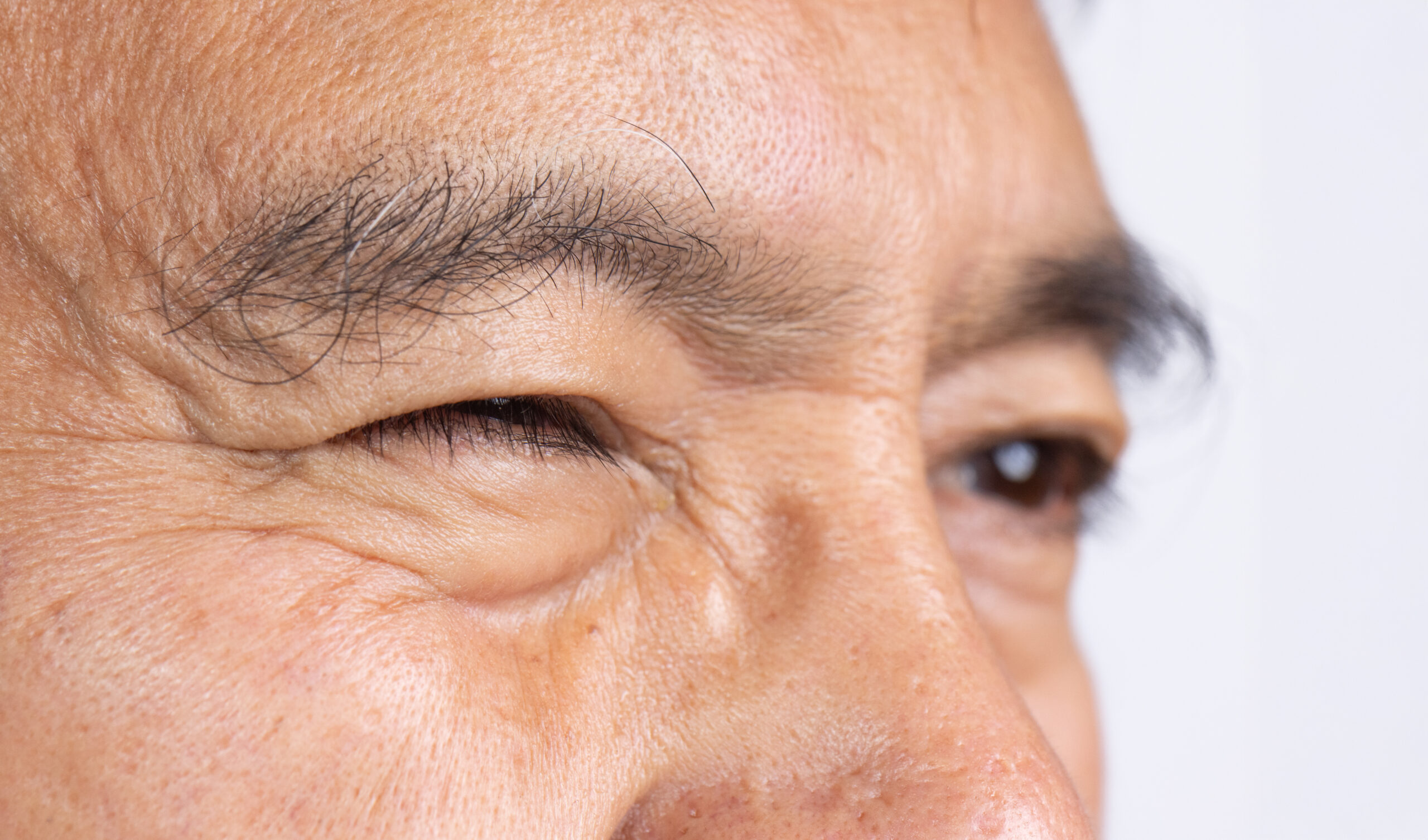 Senior man eye strain after for long stretches at digital screens.
