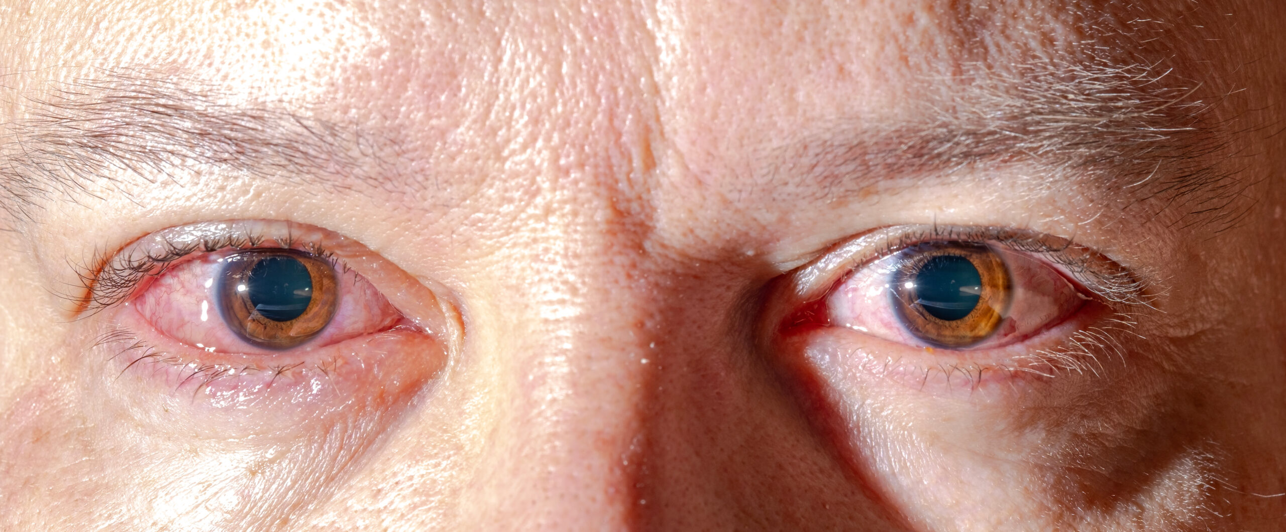 Red inflamed eyes of a man, vessels in the eyes are visible, detachment of the film of the eye. Eye problems, infection, drug exposure, alcohol intoxication.