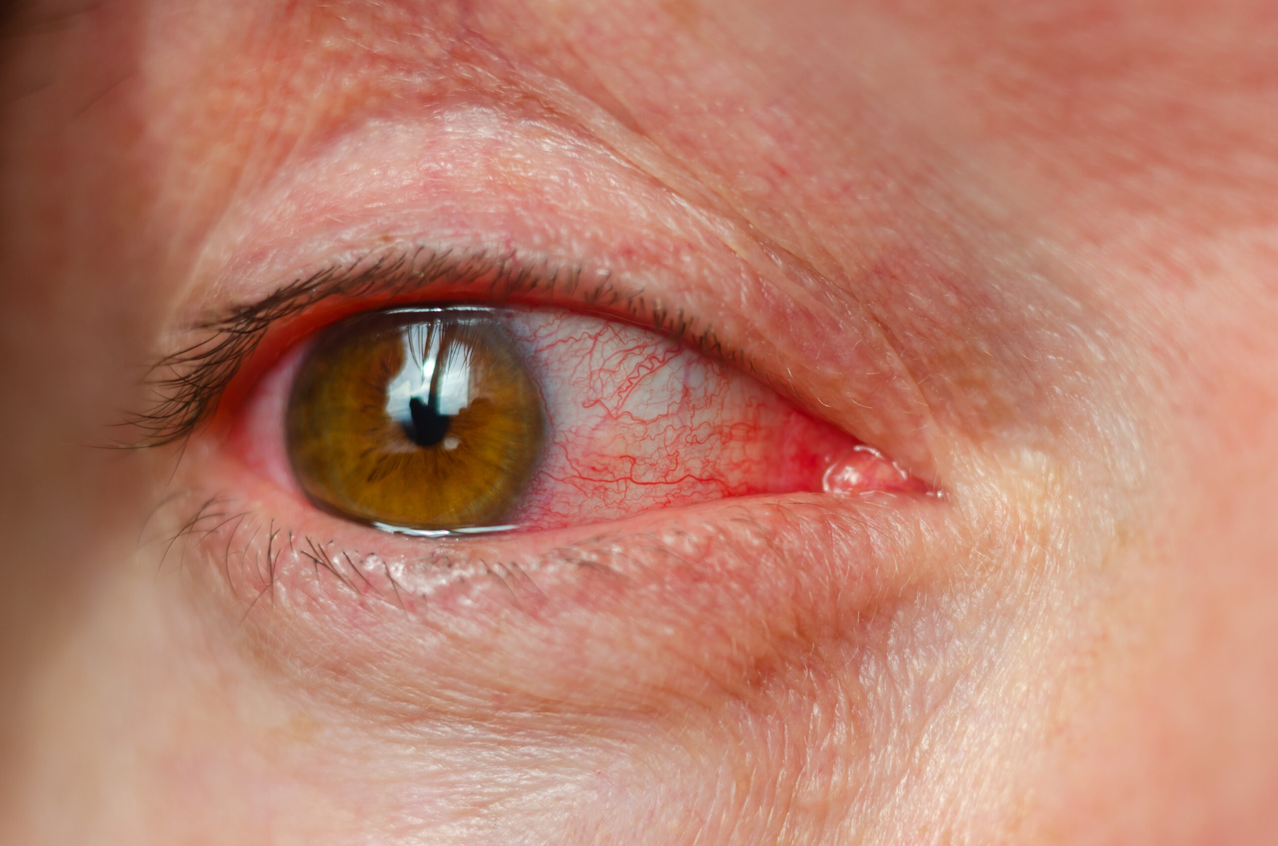Closeup irritated infected red bloodshot eyes, conjunctivitis.