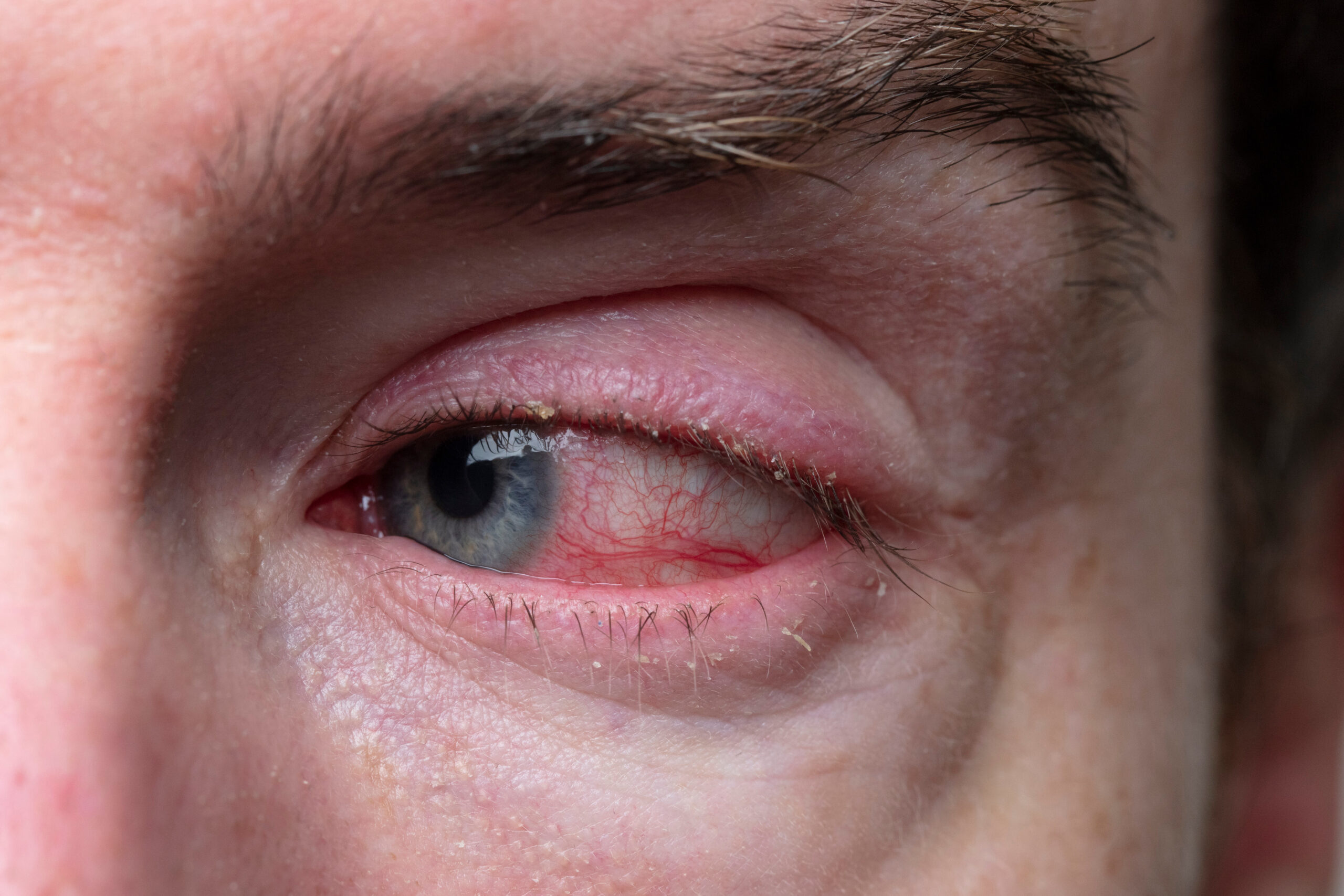 Close up of a severe bloodshot eye. Blepharitis, Conjunctivitis condition