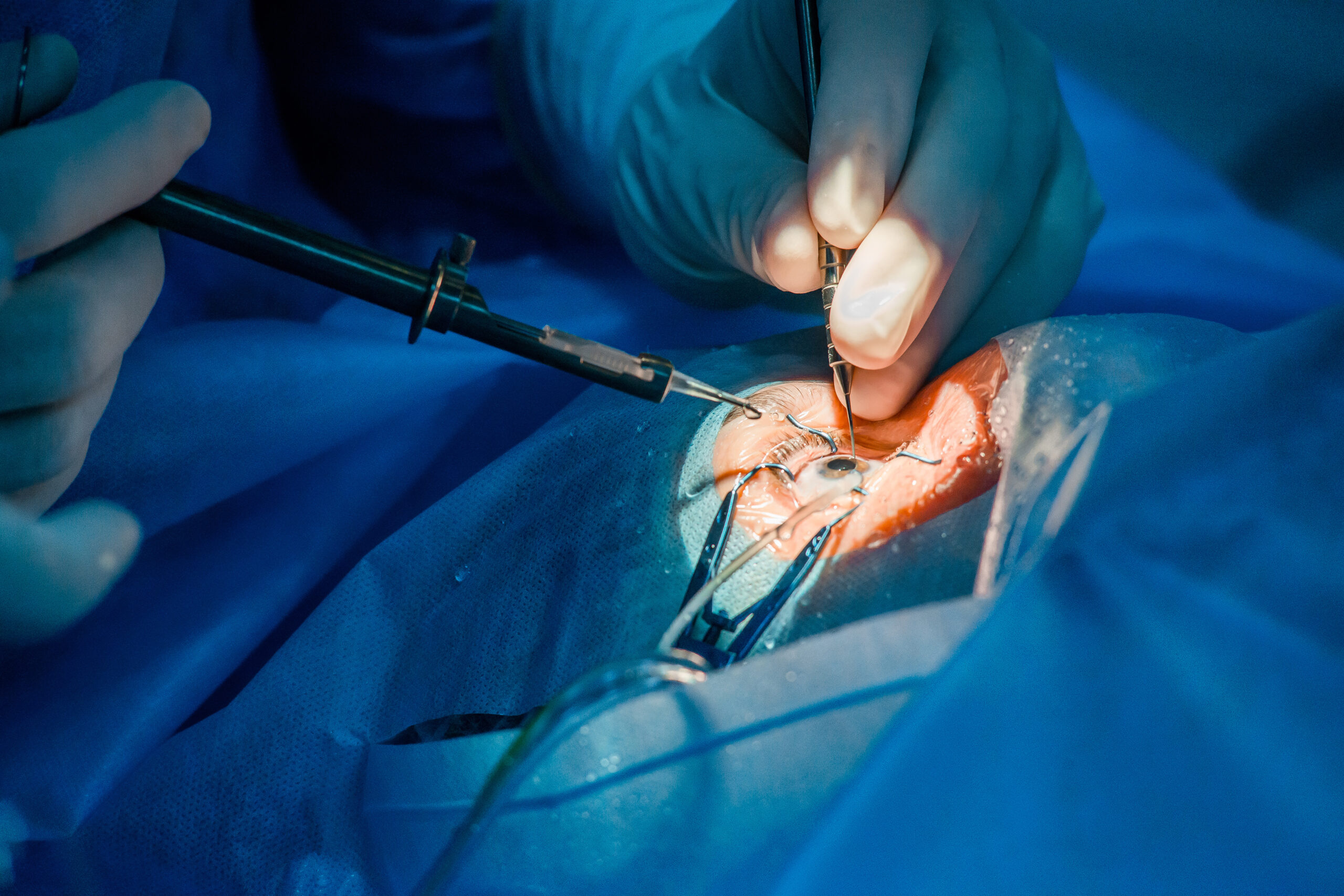 Clinic operation on the patient's eye