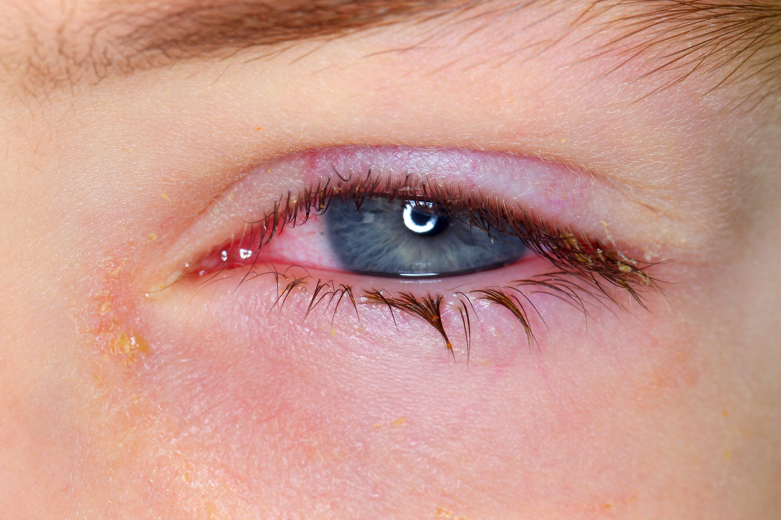 Belarus, Minsk, 2019. Conjunctivitis is a viral bacterial infection in the eye of a boy.