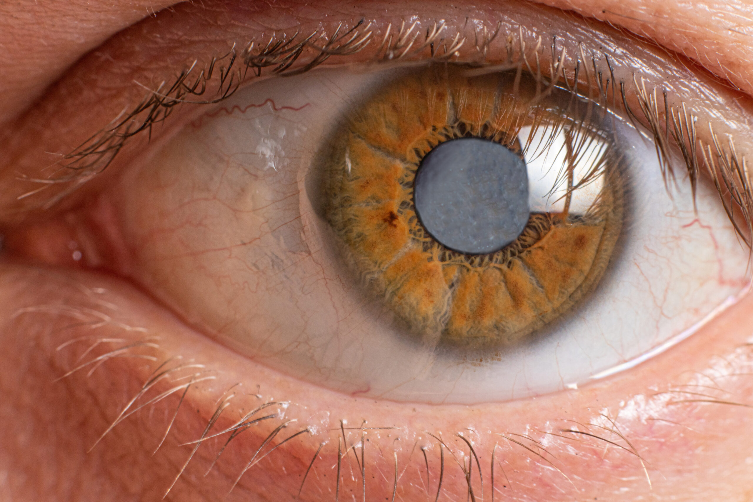 Macro photos of the human eye - cataract clouding of the lens, deterioration of vision. Cataract treatment, surgery and ophthalmology