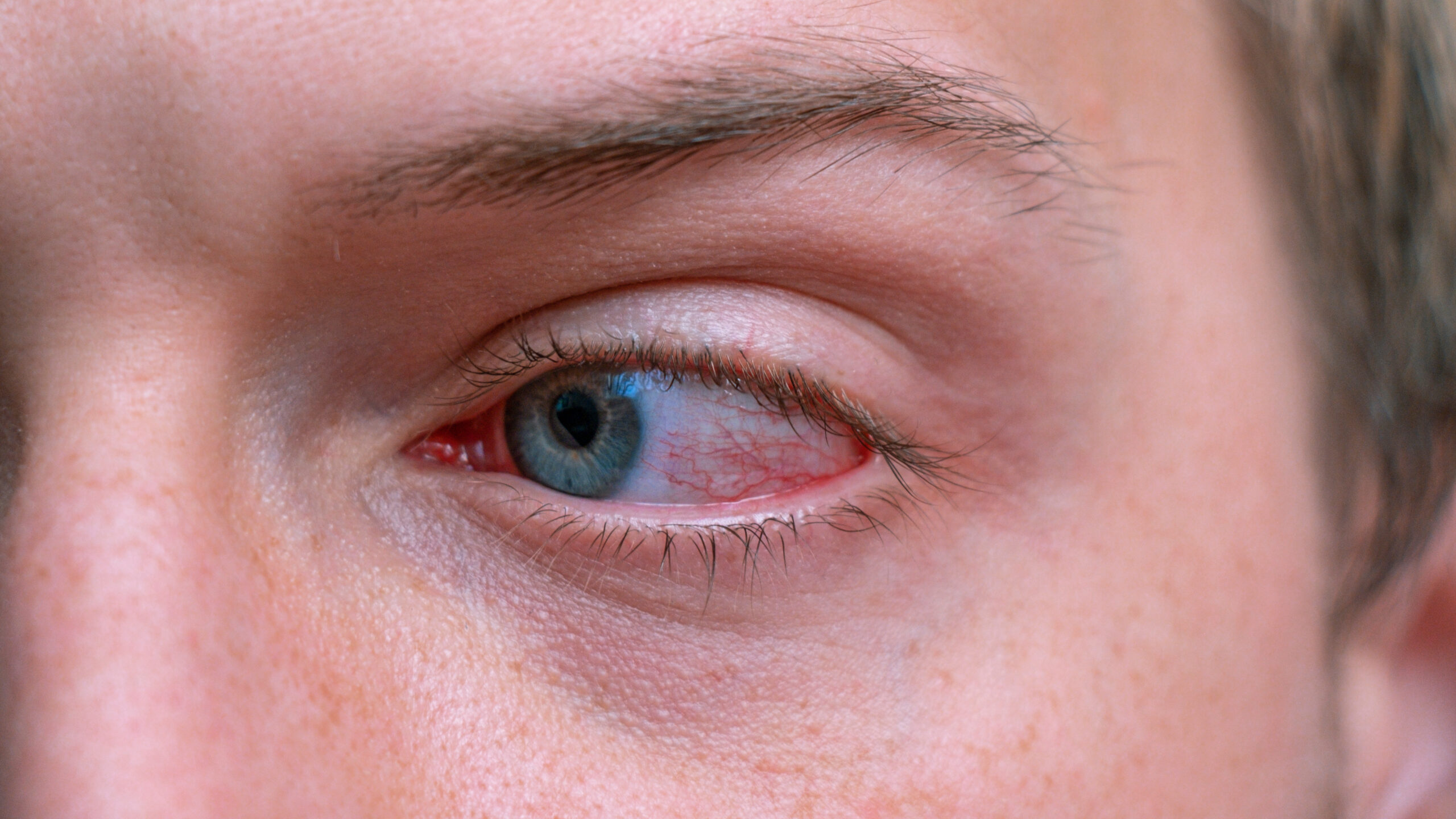Close up irritated infected red bloodshot eyes. Conjunctivitis. Inflammation of the eyes. Mens red eye close-up, fatigue, problems with blood vessels. Red eye for irritation of the sclera