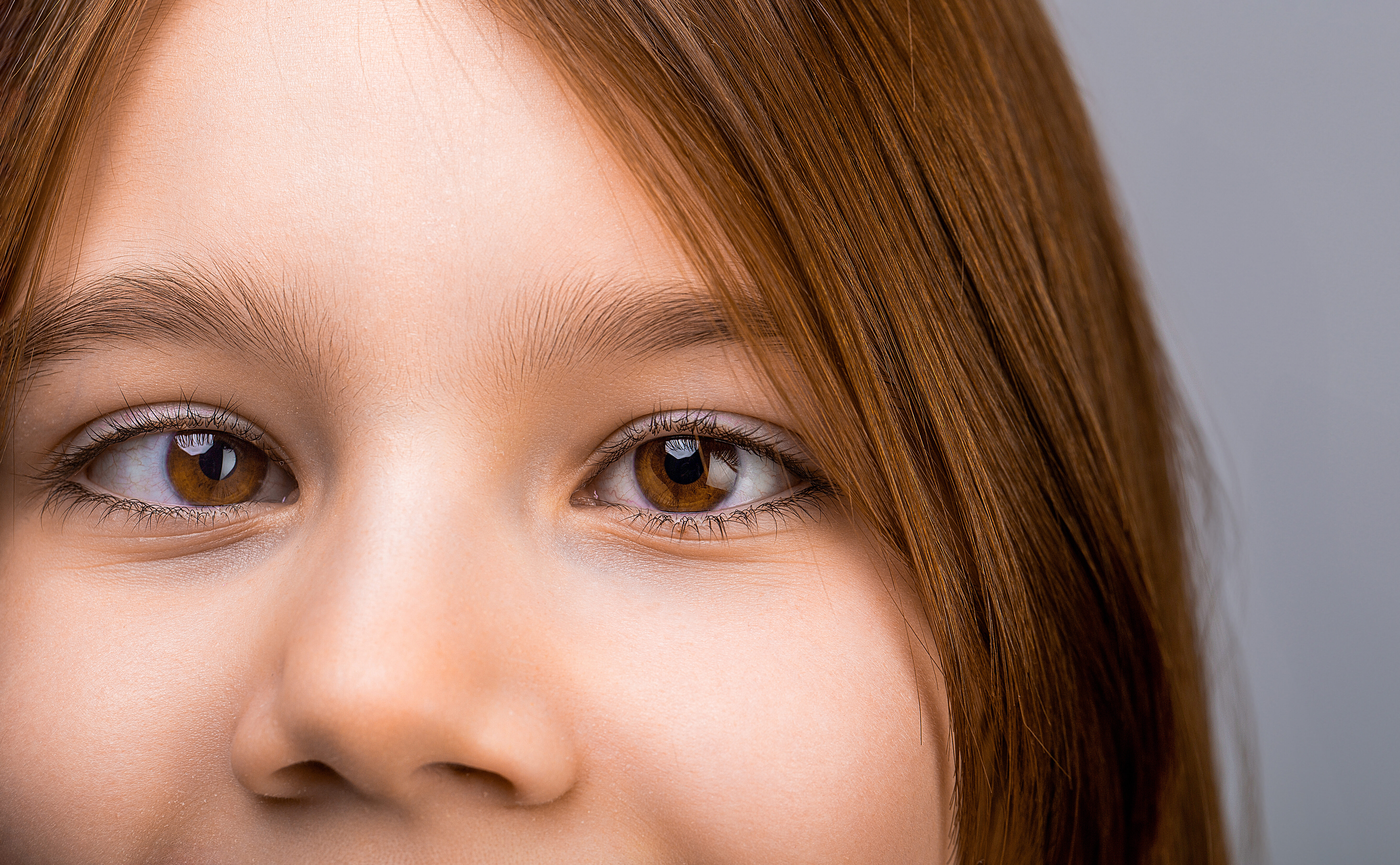 Strabismus in children causes, treatment concept. Female eyes with strabismus. Hypertropia. Strabismus. Closeup part child's face, eyes girl. Little patient strabismus, treatment ophthalmic diseases.