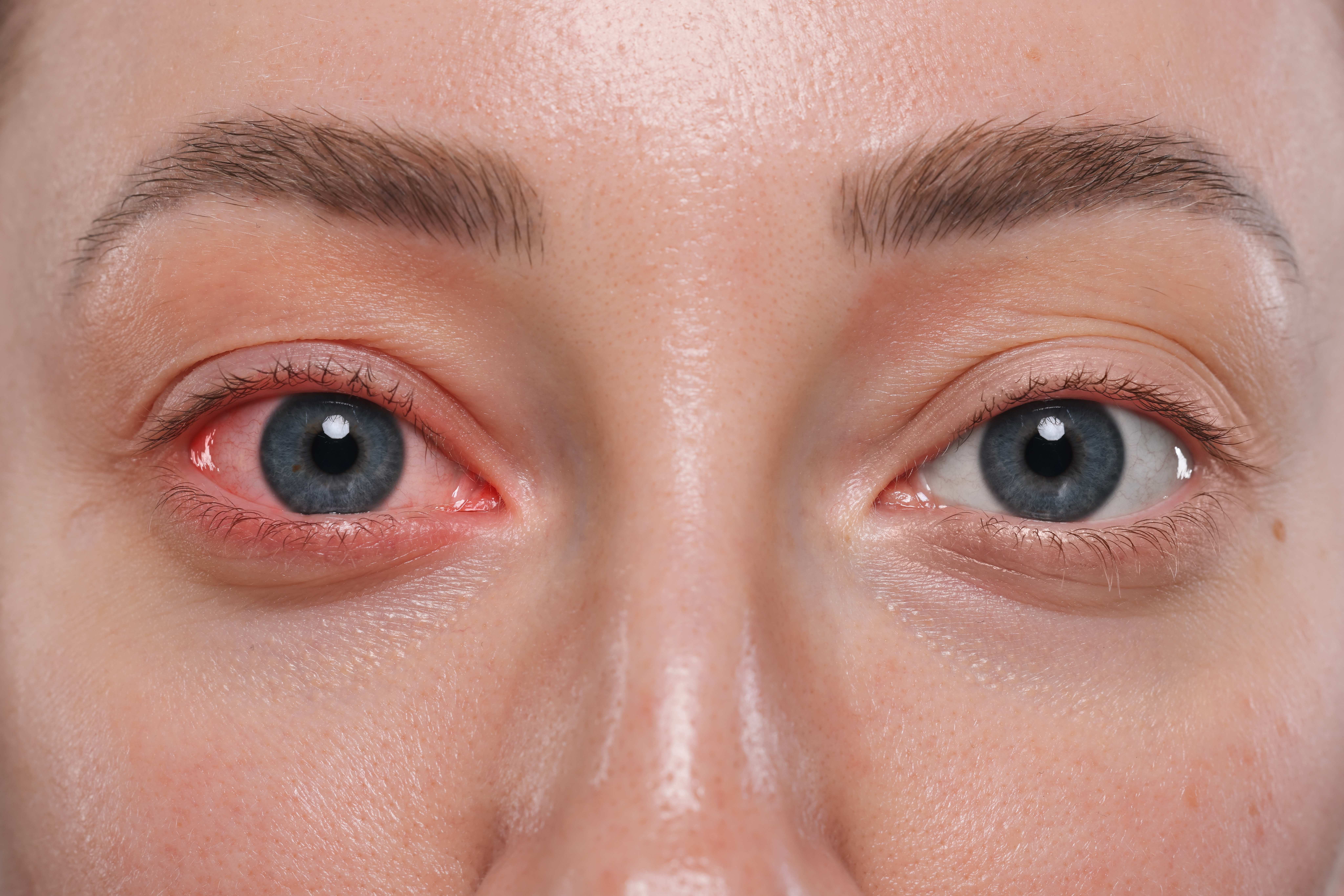 Woman with red eye suffering from conjunctivitis, closeup