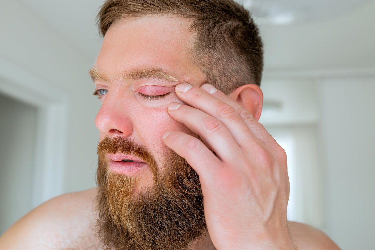 Man having eye problem