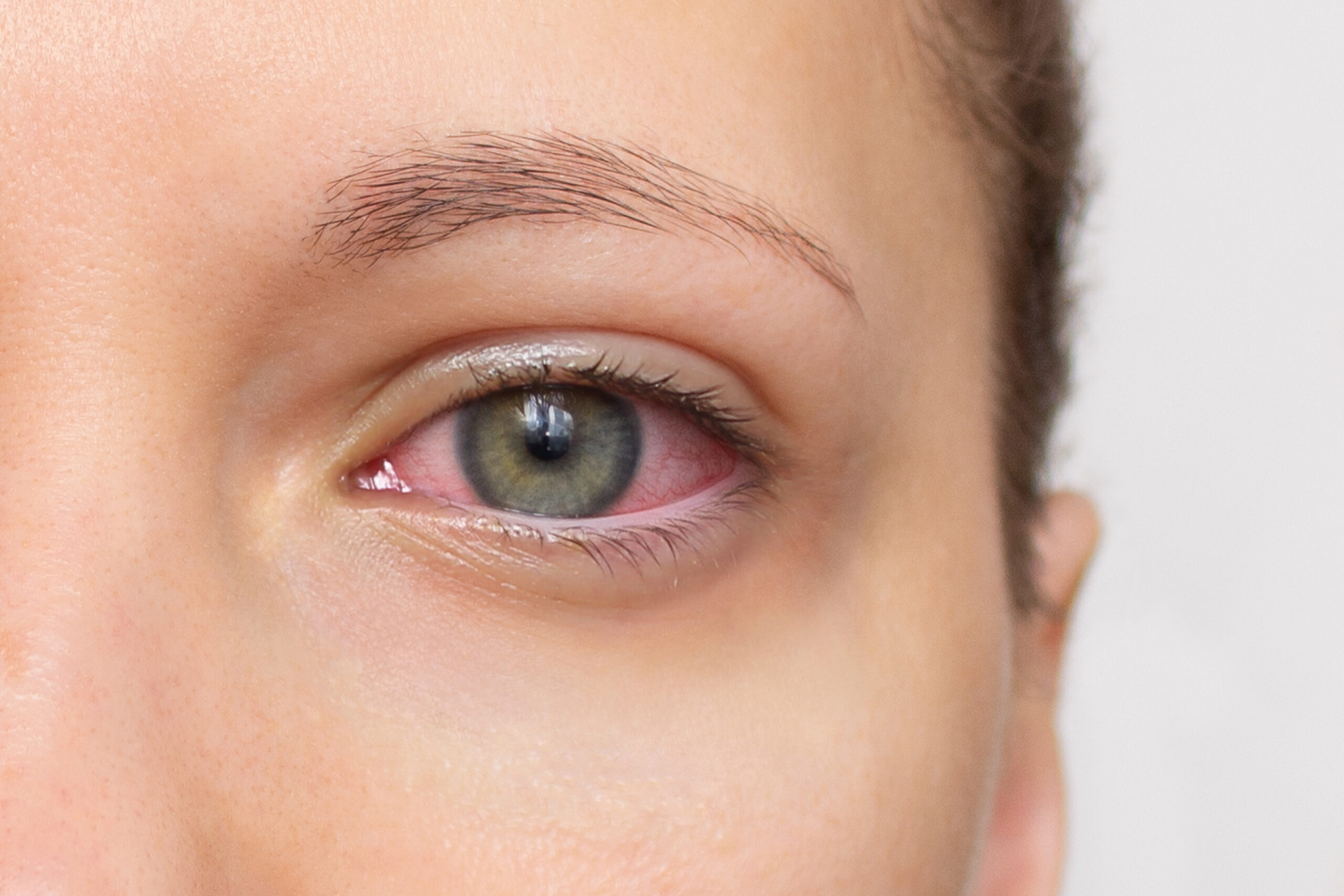 Close up of woman face with red eye. Swollen eyelids, irritation and itching of eyes caused by conjunctivitis, allergy, inflammation, infection. Dry eye syndrome