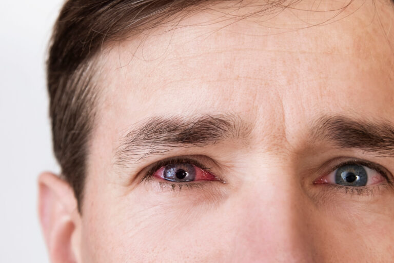 The man's face is close up on a light background, the man has red eyes because he has conjunctivitis, caught a cold and now drips special eye drops, medical concept