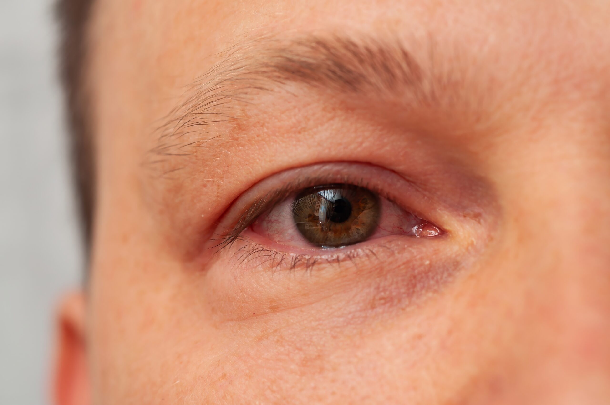 Close-up shot of a human eye affected by conjunctivitis, showing redness and inflammation.