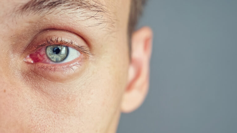 Close up of the red eye of a man affected by an infection, copy space