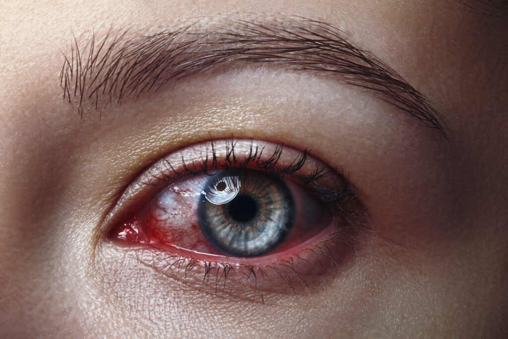 Close-up macro of a gray eye with burst red blood vessels due to insomnia, infection, contact lenses, or allergies. Concept photo for Halloween, horror, and an ophthalmology clinic.