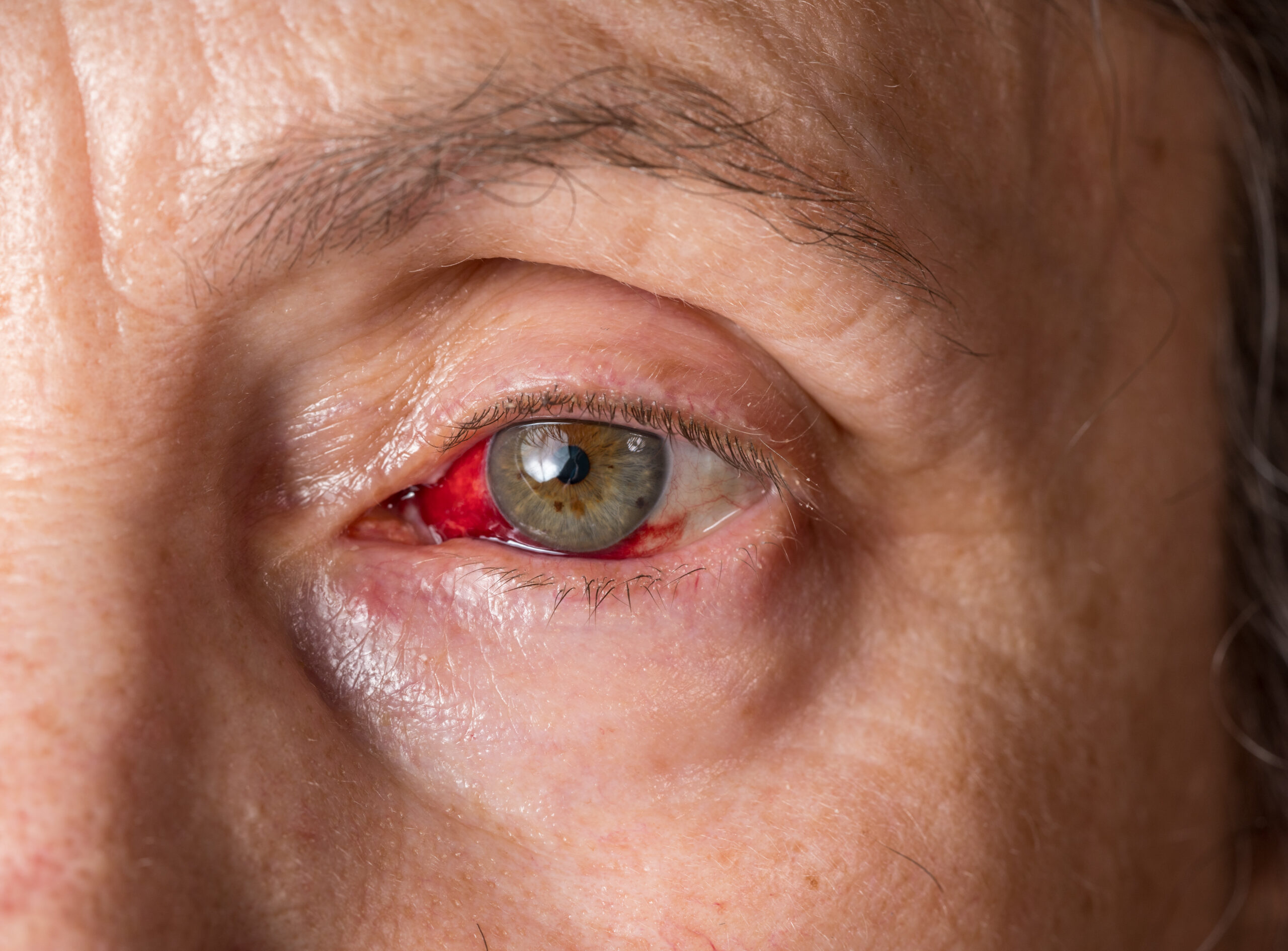 Macro close image of a female eye with deep red coloration due to conjunctivitis or pink eye